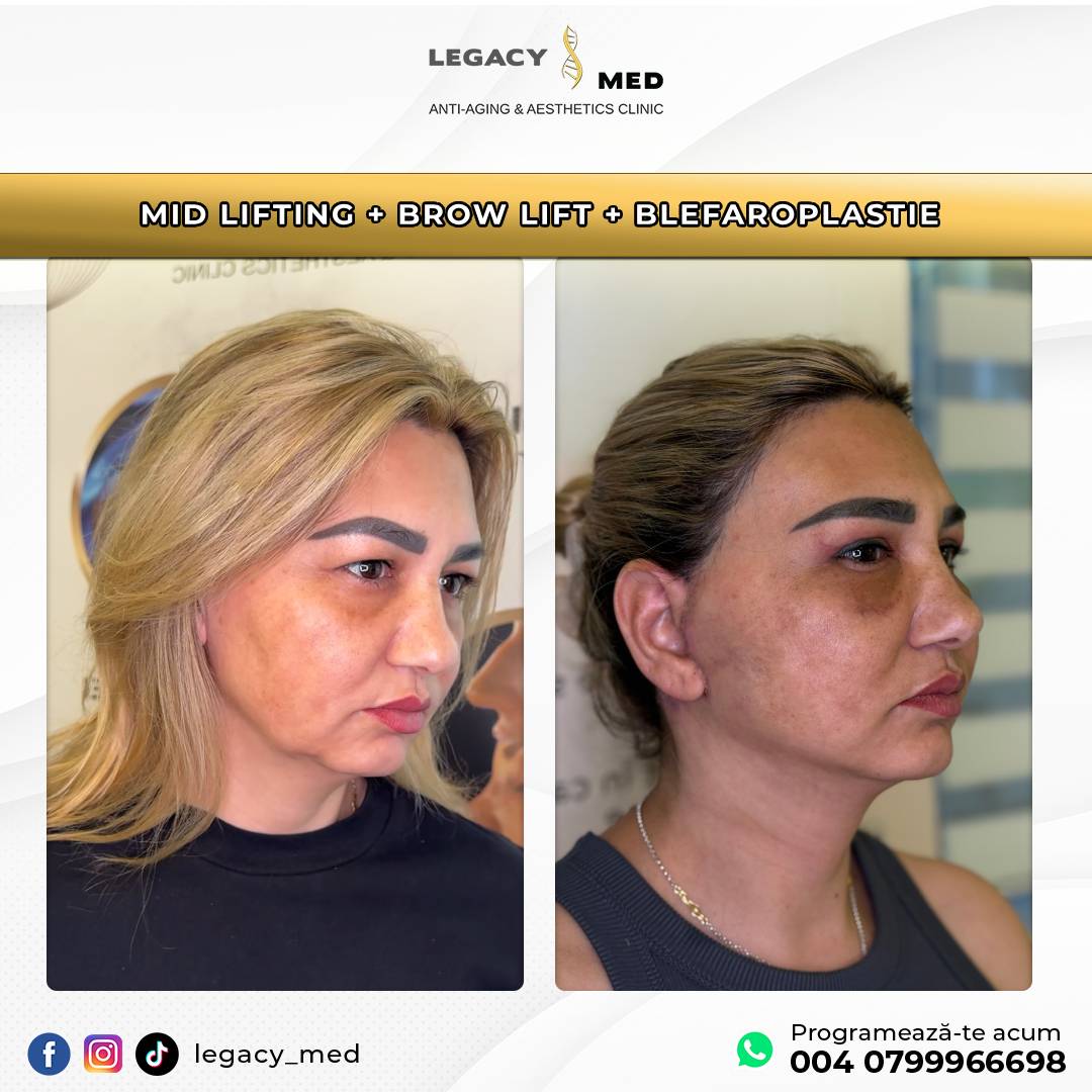 MID LIFTING CU BROW LIFT SI BLEFAROPLASTIE